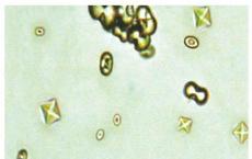 介绍下尿液中的草酸钙结晶是什么