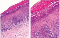 西奈山研究人员发现局部治疗可改善慢性斑块状牛皮癣