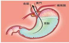 介绍下胃酸分析的临床意义是什么