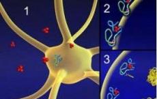 研究确定了亨廷顿舞蹈病的新生物标志物