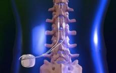 高频脊髓刺激可改善慢性腰腿疼痛