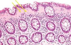 CRISPR-Cas系统可用于有效靶向结肠炎病原体