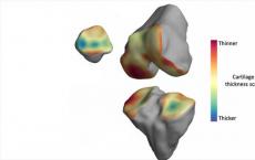 MRI扫描有助于发展关节炎治疗方法