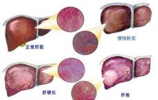 科普下在发生肝硬化的时候层粘连蛋白有什么变化