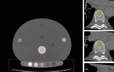 心脏CT检查有可能将骨质疏松症的治疗速度提高到以前未拥