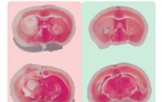 新药可减轻小鼠的中风损害