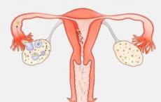 心脏病的家族史使卵巢过早摘除变得特别危险