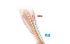 研究人员发现用于治疗慢性跟腱疾病的微创手术可改善患者